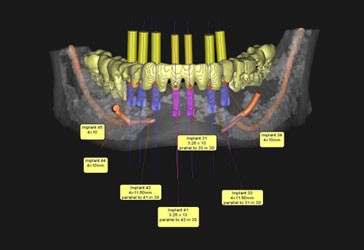 Treatment Planning