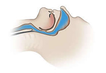Normal open airway