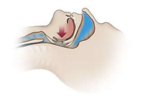 Partially obstructed airway (Snoring and UARS)
